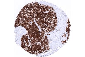 Hepatocellular carcinoma showing strong nuclear and cytoplasmic arginase 1 positivity in all tumor cells (Rekombinanter Liver Arginase Antikörper  (AA 300-400))
