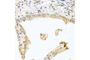 Immunohistochemistry of paraffin-embedded human lung cancer using PRKCA antibody. (PKC alpha Antikörper  (C-Term))