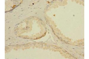 Immunohistochemistry of paraffin-embedded human prostate cancer using ABIN7158328 at dilution of 1:100 (LNX2 Antikörper  (AA 201-500))