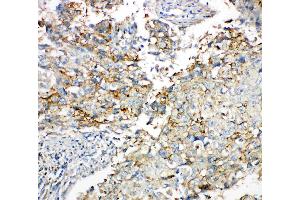Anti-Connexin 43/GJA1 antibody, IHC(P): Human Lung Cancer Tissue (Connexin 43/GJA1 Antikörper  (C-Term))