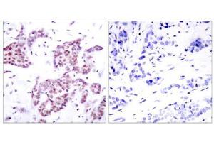 Immunohistochemical analysis of paraffin-embedded human breast carcinoma tissue using STAT6 (phospho- Tyr641) antibody (E011050). (STAT6 Antikörper  (pTyr641))