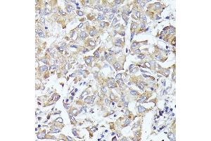 Immunohistochemistry of paraffin-embedded human liver cancer using EIF3L antibody (ABIN6131772, ABIN6140074, ABIN6140075 and ABIN6225315) at dilution of 1:100 (40x lens).