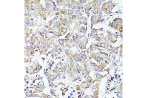Immunohistochemistry of paraffin-embedded human liver cancer using EIF3L antibody (ABIN6131772, ABIN6140074, ABIN6140075 and ABIN6225315) at dilution of 1:100 (40x lens). (EIF3L Antikörper  (AA 1-230))
