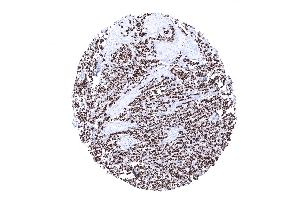 Invasive lobular breast cancer showing strong diffuse CKpan positivity in tumor cells (Rekombinanter pan Keratin Antikörper)
