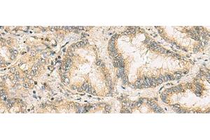 Immunohistochemistry of paraffin-embedded Human lung cancer tissue using NANP Polyclonal Antibody at dilution of 1:65(x200) (NANP Antikörper)