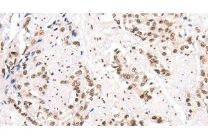 Immunohistochemistry of paraffin-embedded Human prostate cancer using CTBP2 Polyclonal Antibody at dilution of 1:40 (CTBP2 Antikörper)
