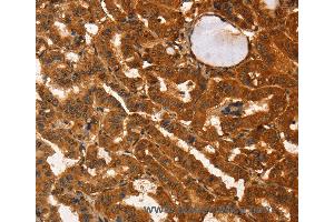 Immunohistochemistry of Human liver cancer using IKZF3 Polyclonal Antibody at dilution of 1:60
