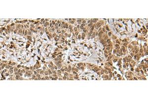 Immunohistochemistry of paraffin-embedded Human ovarian cancer tissue using BCL7B Polyclonal Antibody at dilution of 1:85(x200) (BCL7B Antikörper)