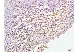 Formalin-fixed and paraffin embedded human cervical cancer labeled with Anti P45017A1 Polyclonal Antibody,Unconjugated  at 1:200 followed by conjugation to the secondary antibody and DAB staining. (CYP17A1 Antikörper  (AA 24-65))