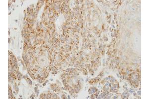 IHC-P Image Immunohistochemical analysis of paraffin-embedded human oral cancer, using PGP9. (UCHL1 Antikörper  (C-Term))