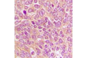 Immunohistochemical analysis of Caspase 9 p35 staining in human breast cancer formalin fixed paraffin embedded tissue section. (Caspase 9 p35 (C-Term) Antikörper)