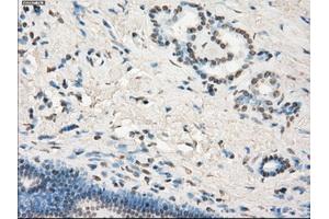 Immunohistochemical staining of paraffin-embedded Adenocarcinoma of colon tissue using anti-LTA4Hmouse monoclonal antibody. (LTA4H Antikörper)