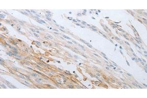 Immunohistochemistry of paraffin-embedded Human cervical cancer using LOX Polyclonal Antibody at dilution of 1:30 (LOX Antikörper)