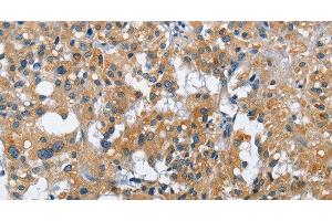 Immunohistochemistry of paraffin-embedded Human thyroid cancer tissue using CREB2 Polyclonal Antibody at dilution 1:40 (ATF4 Antikörper)