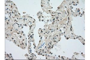 Immunohistochemical staining of paraffin-embedded Adenocarcinoma of breast tissue using anti-NAT8 mouse monoclonal antibody. (NAT8 Antikörper)