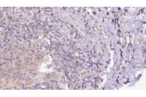 ABIN6273162 at 1/100 staining Human lymph cancer tissue by IHC-P. (SH2D1B Antikörper  (Internal Region))
