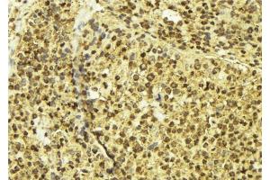 ABIN6277602 at 1/100 staining Human breast cancer tissue by IHC-P. (OTX2 Antikörper  (Internal Region))