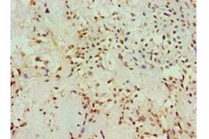 Immunohistochemistry of paraffin-embedded human breast cancer using ABIN7142904 at dilution of 1:100 (AKAP13 Antikörper  (AA 1-150))