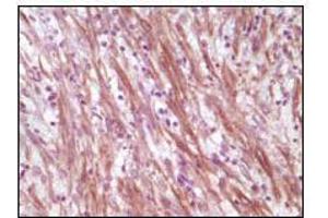 Immunohistochemical analysis of paraffin-embedded human smooth musde sarcoma, showing cytoplasmic localization using Desmin mouse mAb with DAB staining. (Desmin Antikörper)