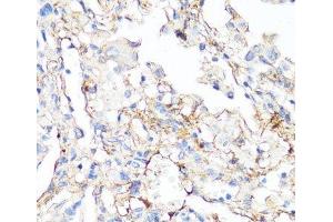 Immunohistochemistry of paraffin-embedded Human lung cancer using Fibronectin Polyclonal Antibody at dilution of 1:100 (40x lens). (Fibronectin Antikörper)