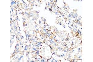 Immunohistochemistry of paraffin-embedded Human lung cancer using Fibronectin Polyclonal Antibody at dilution of 1:100 (40x lens).