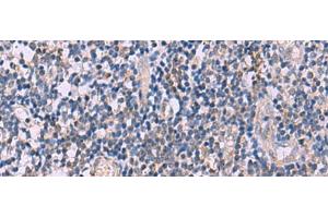 Immunohistochemistry of paraffin-embedded Human tonsil tissue using IL4R Polyclonal Antibody at dilution of 1:45(x200) (IL4 Receptor Antikörper)