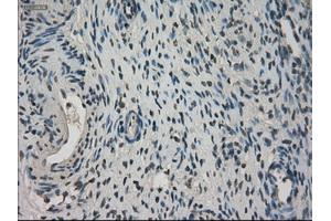 Immunohistochemical staining of paraffin-embedded Adenocarcinoma of breast tissue using anti-NEK6 mouse monoclonal antibody.