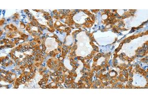 Immunohistochemistry of paraffin-embedded Human thyroid cancer using KRT40 Polyclonal Antibody at dilution of 1:50 (KRT40 Antikörper)