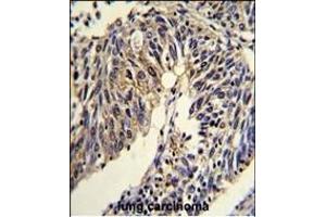 Formalin-fixed and paraffin-embedded human lung carcinoma reacted with TNFRSF14 Antibody (Center), which was peroxidase-conjugated to the secondary antibody, followed by DAB staining. (HVEM Antikörper  (AA 210-236))