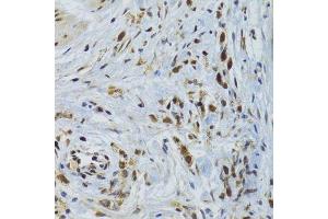 Immunohistochemistry of paraffin-embedded human gastric cancer using GABPB1 Antibody. (GABPB1 Antikörper  (AA 231-395))