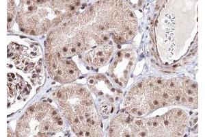ABIN6267703 at 1/100 staining human kindey carcinoma tissue sections by IHC-P. (PRKAB1 Antikörper  (pSer181))