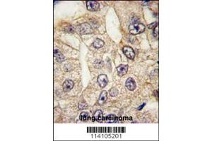 Formalin-fixed and paraffin-embedded human lung carcinoma tissue reacted with CD14 antibody (N-term), which was peroxidase-conjugated to the secondary antibody, followed by DAB staining. (CD14 Antikörper  (N-Term))