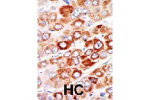Formalin-fixed and paraffin-embedded human hepatocellular carcinoma tissue reacted with AK1 polyclonal antibody  , which was peroxidase-conjugated to the secondary antibody, followed by AEC staining. (Adenylate Kinase 1 Antikörper  (C-Term))