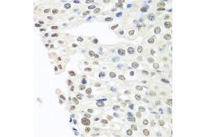 Immunohistochemistry of paraffin-embedded human prostate cancer using TARDBP antibody. (TARDBP Antikörper  (AA 1-100))