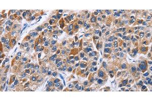 Immunohistochemistry of paraffin-embedded Human liver cancer tissue using ENPP5 Polyclonal Antibody at dilution 1:40 (ENPP5 Antikörper)