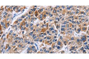 Immunohistochemistry of paraffin-embedded Human liver cancer tissue using ENPP5 Polyclonal Antibody at dilution 1:40