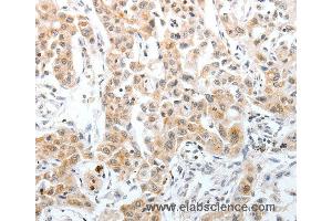 Immunohistochemistry of Human lung cancer using SLC22A3 Polyclonal Antibody at dilution of 1:40 (OCT4 Antikörper)