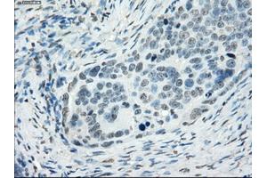 Immunohistochemical staining of paraffin-embedded colon tissue using anti-SSX2mouse monoclonal antibody.