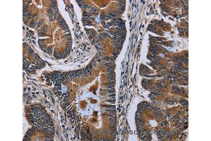 Immunohistochemistry of Human colon cancer using SLC1A6 Polyclonal Antibody at dilution of 1:40