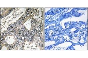 Immunohistochemistry analysis of paraffin-embedded human colon carcinoma tissue, using GUF1 Antibody. (GUF1 Antikörper  (AA 421-470))