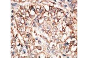 IHC analysis of FFPE human hepatocarcinoma tissue stained with the BMPR1A antibody (BMPR1A Antikörper  (AA 166-196))