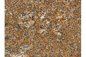 The image on the left is immunohistochemistry of paraffin-embedded Human liver cancer tissue using ABIN7191682(NPAP1 Antibody) at dilution 1/60, on the right is treated with synthetic peptide.