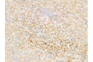 ABIN6255593 and ABIN6267543 at 1/100 staining human hepatocellular carcinoma by IHC-P.