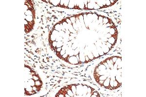 Immunohistochemistry of paraffin-embedded human colon carcinoma using Cytokeratin 13 (Cytokeratin 13 (KRT13)) antibody (ABIN7268090) at dilution of 1:100 (40x lens). (Cytokeratin 13 Antikörper  (AA 269-458))