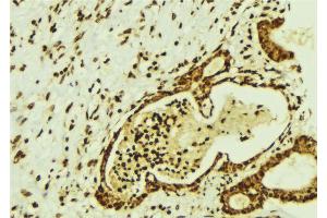 ABIN6274350 at 1/100 staining Human breast cancer tissue by IHC-P. (CBFB Antikörper  (N-Term))