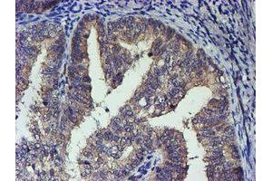Immunohistochemical staining of paraffin-embedded Adenocarcinoma of Human endometrium tissue using anti-TCP11L2 mouse monoclonal antibody. (TCP11L2 Antikörper)