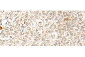 Immunohistochemistry of paraffin-embedded Human ovarian cancer tissue using OTX1 Polyclonal Antibody at dilution of 1:30(x200) (OTX1 Antikörper)