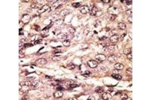 IHC analysis of FFPE human hepatocarcinoma tissue stained with the ATG7 antibody