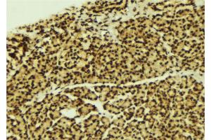 ABIN6269272 at 1/100 staining Human breast cancer tissue by IHC-P. (CEBPA Antikörper  (N-Term))