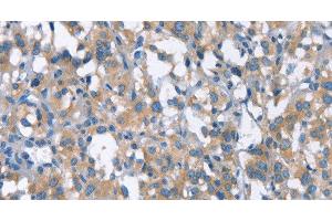 Immunohistochemistry of paraffin-embedded Human thyroid cancer using CDC25A Polyclonal Antibody at dilution of 1:50 (CDC25A Antikörper)